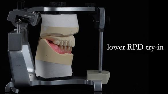 Newsletter 82 Mary - A complete upper and a one-tooth gasket denture