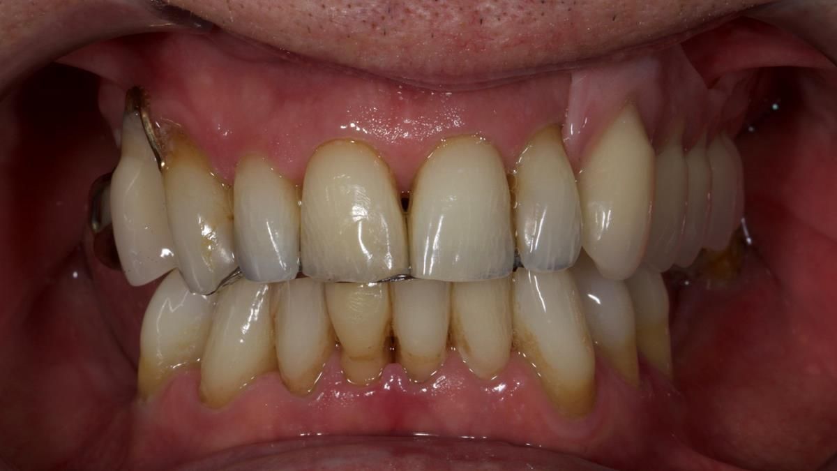 Newsletter 89 – Simon: A Challenging Kennedy Class II Division 1 Upper CoCr Partial Denture with a High Smile Line