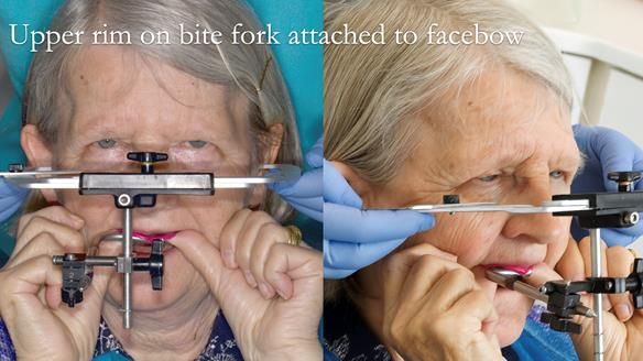 Newsletter 82 Mary - A complete upper and a one-tooth gasket denture