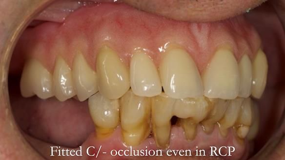 Newsletter 54 case presentation upper complete denture and lower Scandinavian designed hygienic partial denture for David