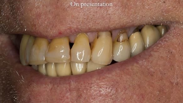 Ken – going downhill, first class