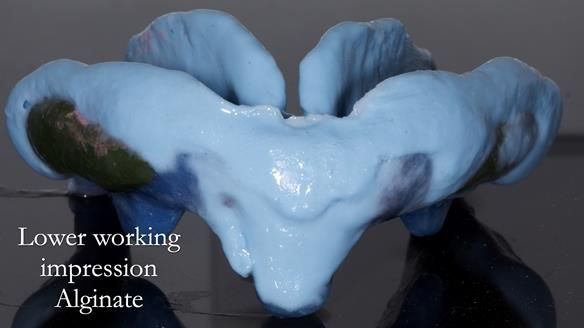 Newsletter 53 showing the making and fitting of ultra life-like dentures for Valena