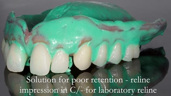Newsletter 53 showing the making and fitting of ultra life-like dentures for Valena