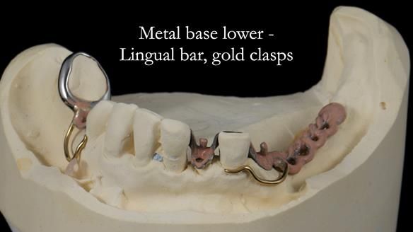 Newsletter 55 Provision of metal based partial dentures for Zephyrine with a repaired cleft lip and palate