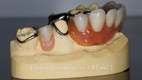 Eileen's transformation with upper and lower RPDs of Scandinavian hygienic design FULL PROTOCOL