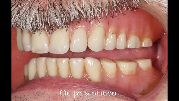 Newsletter 78: What do Clark Gable and a Locator® overdenture have in common?