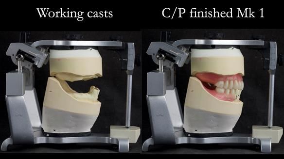 Newsletter 52 Managing Jo’s failing dentition with extractions and Mk 1/Mk 2 complete upper dentures and lower partial dentures FULL PROTOCOL