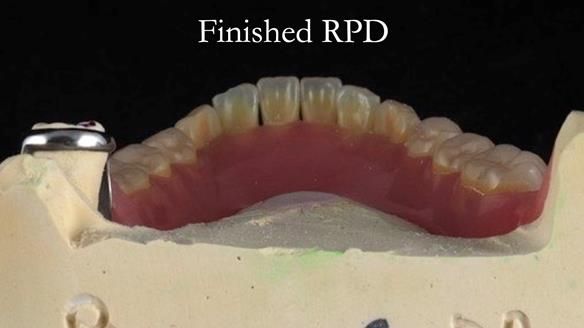 Finlay's Newsletter 59 Ultra hard partial dentures made for Gill