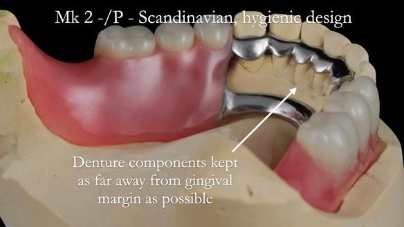 Newsletter 52 Managing Jo’s failing dentition with extractions and Mk 1/Mk 2 complete upper dentures and lower partial dentures FULL PROTOCOL