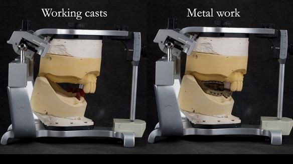 Newsletter 76: Jackie’s case – Telescopic overdenture & precision RPD (the tricky truth!)