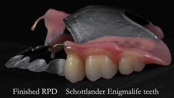 Newsletter 56 showing the making and fitting of a bilateral free end saddle upper removable partial denture (RPD) for patient with pemphigus