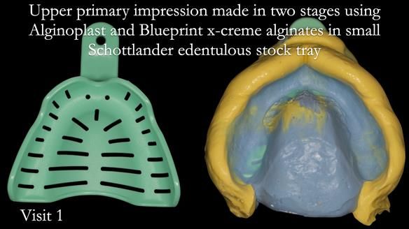 Newsletter 48 Mavis's Complete denture FULL PROTOCOL