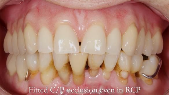 Newsletter 54 case presentation upper complete denture and lower Scandinavian designed hygienic partial denture for David