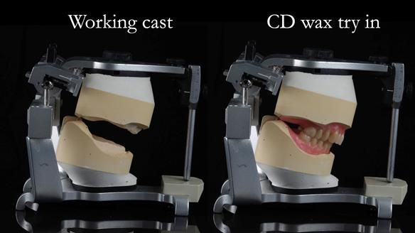 Finlay's Newsletter 62 provision of extractions and metal based complete dentures for Rafique