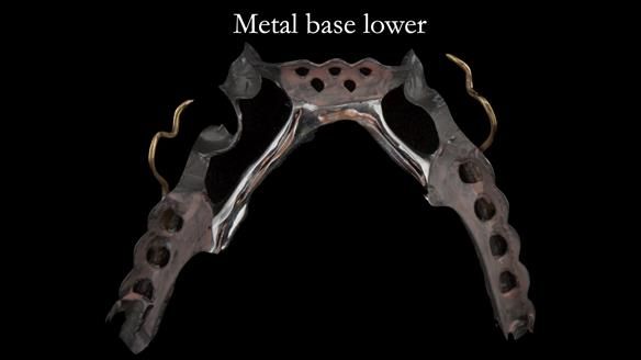 Finlay's Case Study Newsletter 40 - Immediate Mk 1 RPD to Definitive Mk 2 RPD - full protocol