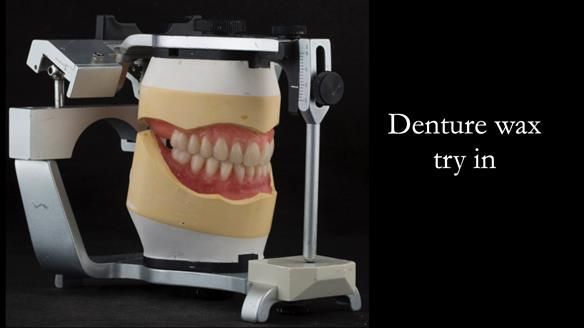 Newsletter 75: Marion’s case - Step-by-step complete denture workflow