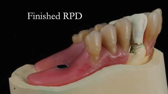 Finlay's Newsletter 59 Ultra hard partial dentures made for Gill
