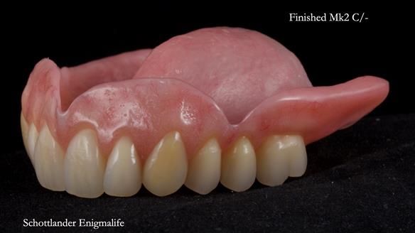 Newsletter 77: Jeremy’s case – immediate complete upper denture