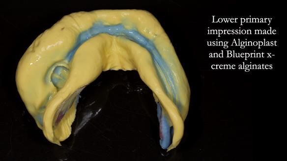 Newsletter 82 Mary - A complete upper and a one-tooth gasket denture