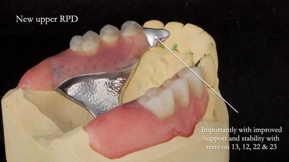 Newsletter 76: Jackie’s case – Telescopic overdenture & precision RPD (the tricky truth!)