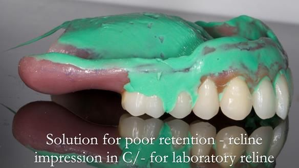 Newsletter 53 showing the making and fitting of ultra life-like dentures for Valena