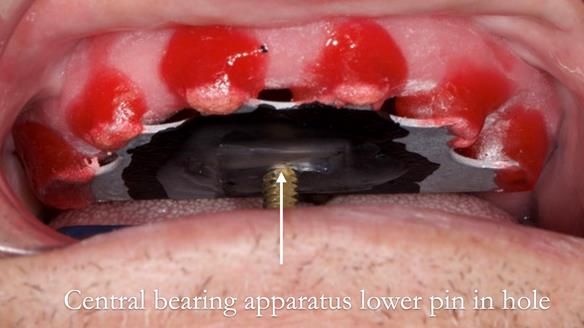 Managing poor implant positioning with complete dentures and Locator attachments - full protocol Newsletter 41