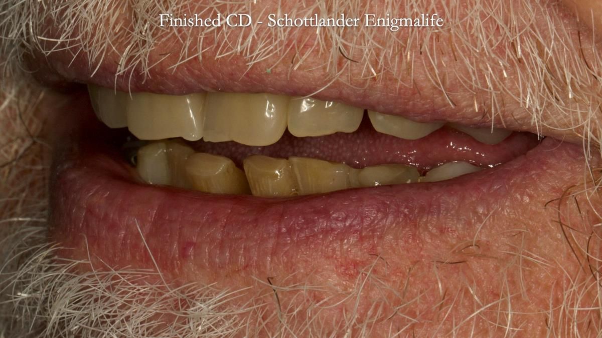 Newsletter 87 – Father Peter: A Partial Denture that needed Minor Miracle