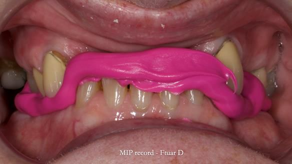 Newsletter 81 - Pam’s Story — how a partial denture changed her life (+ live walkthrough this Thursday)