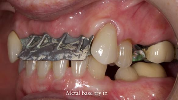 Newsletter 81 - Pam’s Story — how a partial denture changed her life (+ live walkthrough this Thursday)