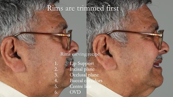 Finlay's Newsletter 62 provision of extractions and metal based complete dentures for Rafique