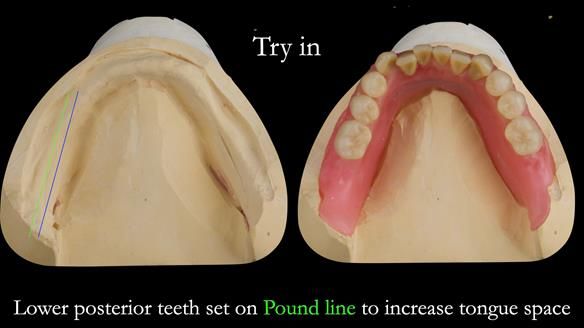 Complete denture Class II div 2 deep overbite Newsletter 39