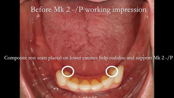 Newsletter 52 Managing Jo’s failing dentition with extractions and Mk 1/Mk 2 complete upper dentures and lower partial dentures FULL PROTOCOL