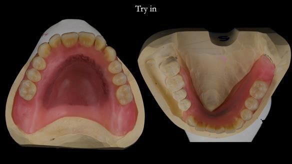 Newsletter 82 Mary - A complete upper and a one-tooth gasket denture