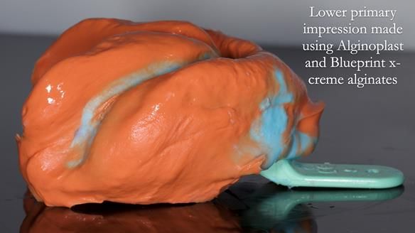 Newsletter 82 Mary - A complete upper and a one-tooth gasket denture