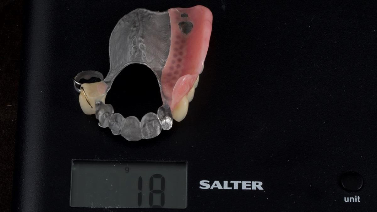 Newsletter 89 – Simon: A Challenging Kennedy Class II Division 1 Upper CoCr Partial Denture with a High Smile Line