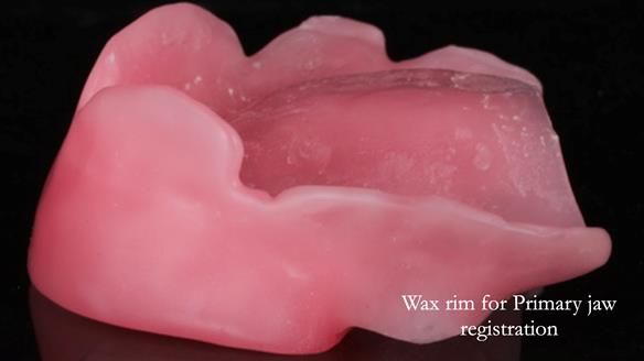 Finlay's Newsletter 58 Gasket upper partial denture for Zoe