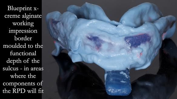 Finlay's Newsletter 61 provision of a lower unilateral free end saddle metal based partial denture for Joyce