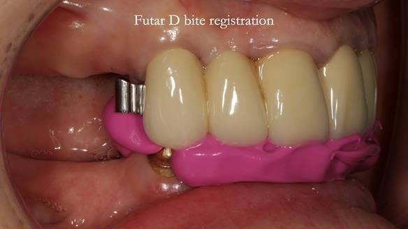 Newsletter 76: Jackie’s case – Telescopic overdenture & precision RPD (the tricky truth!)
