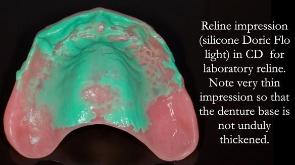 Finlay's Newsletter 62 provision of extractions and metal based complete dentures for Rafique