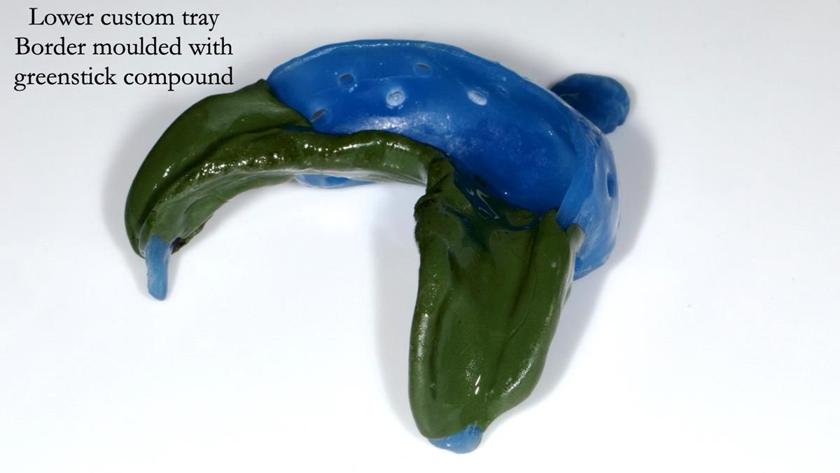 Newsletter 87 – Father Peter: A Partial Denture that needed Minor Miracle