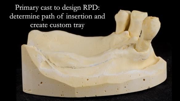 Finlay's Newsletter 59 Ultra hard partial dentures made for Gill