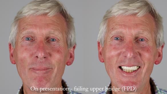 Newsletter 77: Jeremy’s case – immediate complete upper denture