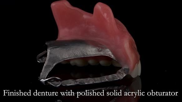 Upper metal base partial denture/occlusal stabilisation splint/obturator - full protocol