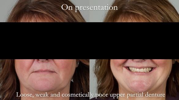 Finlay's Newsletter 58 Gasket upper partial denture for Zoe