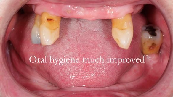 Finlay's Newsletter 59 Ultra hard partial dentures made for Gill