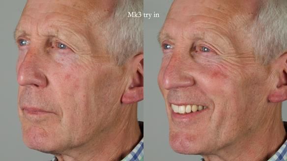 Newsletter 77: Jeremy’s case – immediate complete upper denture