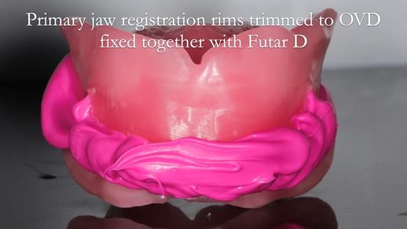 Newsletter 65 Marisa Provision of Complete Dentures on badly placed implants