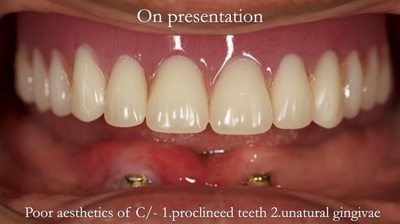 Managing poor implant positioning with complete dentures and Locator attachments - full protocol Newsletter 41