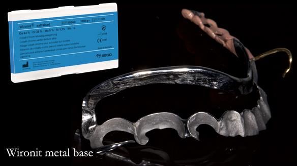 Finlay's Newsletter 61 provision of a lower unilateral free end saddle metal based partial denture for Joyce