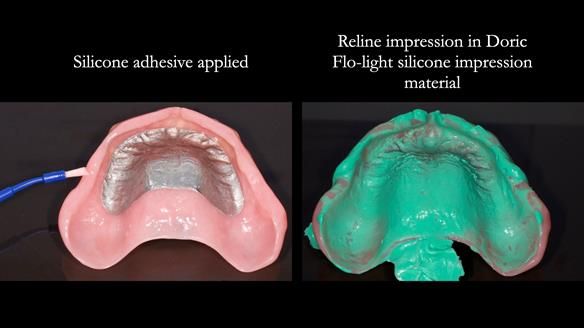 Newsletter 78: What do Clark Gable and a Locator® overdenture have in common?